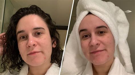 chanel injection vs rejuran|I Got Juvederm Volite, Chanel Injections, Skin Botox .